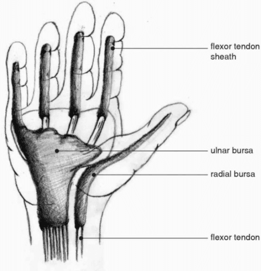 Diagram of the flexor tendon sheaths, radial bursa and ulnar bursa showing their communicating pathways into deep hand spaces.