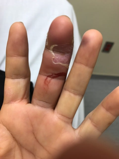 Clinical photograph of a hand with infectious flexor tenosynovitis of the middle finger: fusiform swelling, erythema, semi-flexed posture and a healing entry wound.