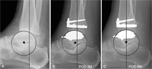 Total ankle arthroplasty progression lateral radiographs