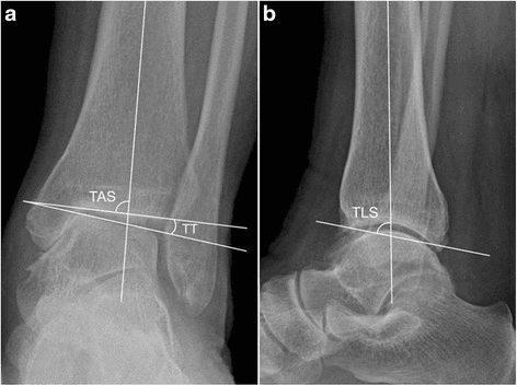 Ankle arthritis radiographic measurements