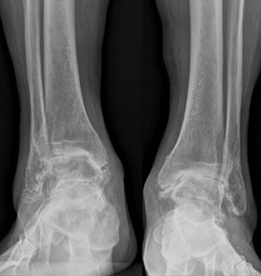 Bilateral end-stage ankle osteoarthritis AP radiographs