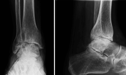 End-stage post-traumatic ankle osteoarthritis radiographs