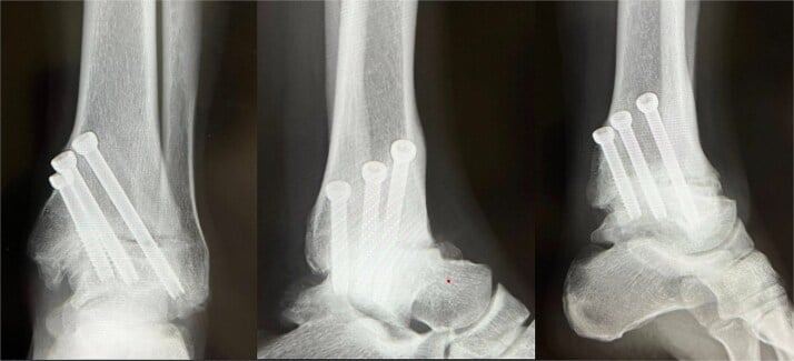 Immediate postoperative ankle arthrodesis radiographs with three cannulated screws