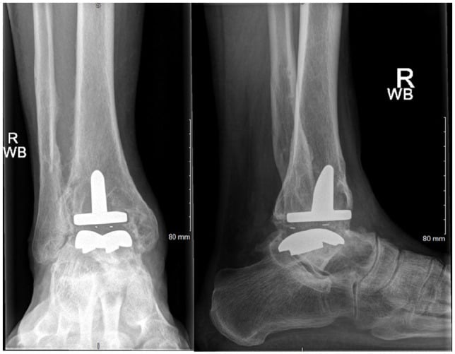 Failed total ankle arthroplasty with a bone defect greater than four centimetres