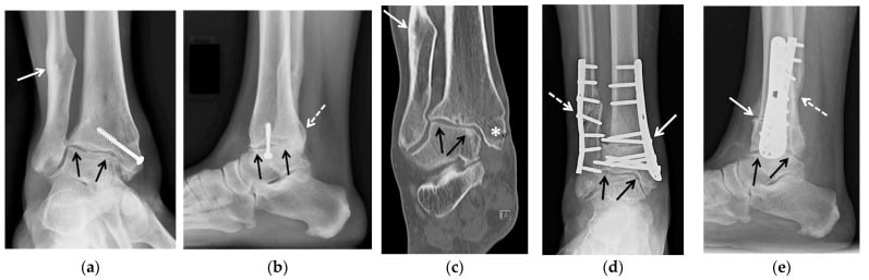 Post-traumatic ankle osteoarthritis before and after tibial opening-wedge and fibular lengthening osteotomies