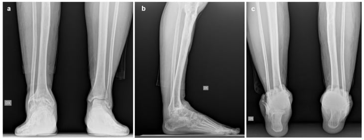 Weight-bearing AP lateral and Saltzman hindfoot alignment radiographs in advanced ankle arthritis