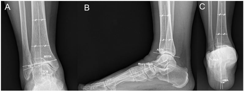 Weight-bearing ankle foot and hindfoot radiographs with measurements used for supramalleolar osteotomy planning