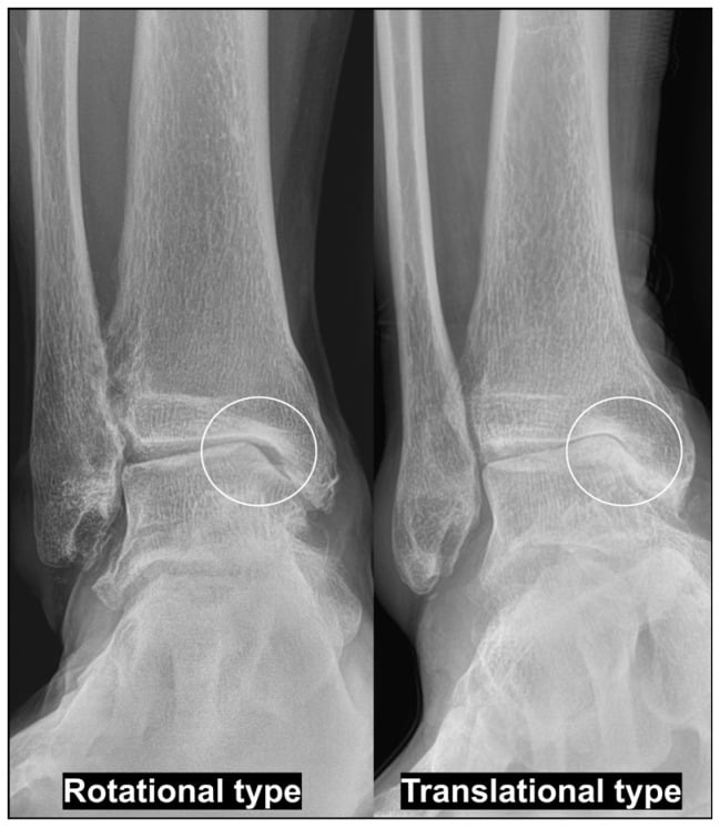 Rotational and translational patterns of varus ankle osteoarthritis on weight-bearing radiographs