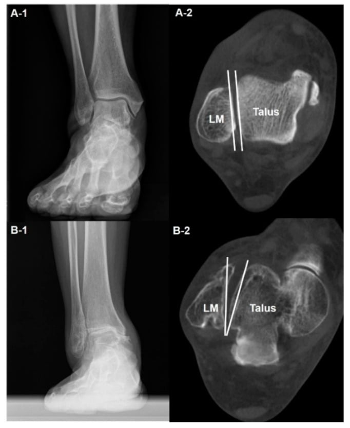 Weight-bearing radiographs and axial weight-bearing CT comparing normal and internally rotated talus in varus ankle osteoarthritis