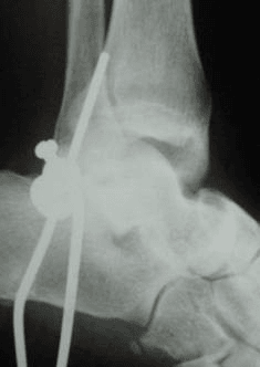 Lateral ankle radiograph showing external fixation after talar dislocation reduction