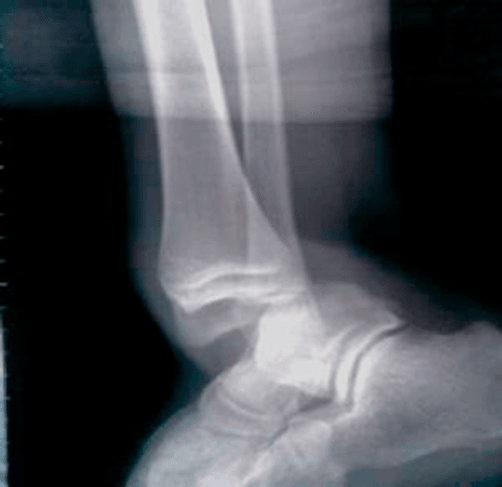 Lateral ankle radiograph showing posteromedial ankle dislocation