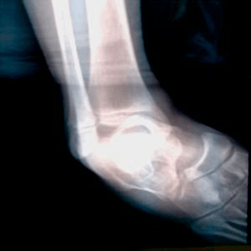 Lateral ankle radiograph showing gross unreduced ankle dislocation