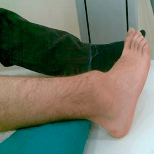 Clinical photo showing normal foot position after successful ankle dislocation reduction