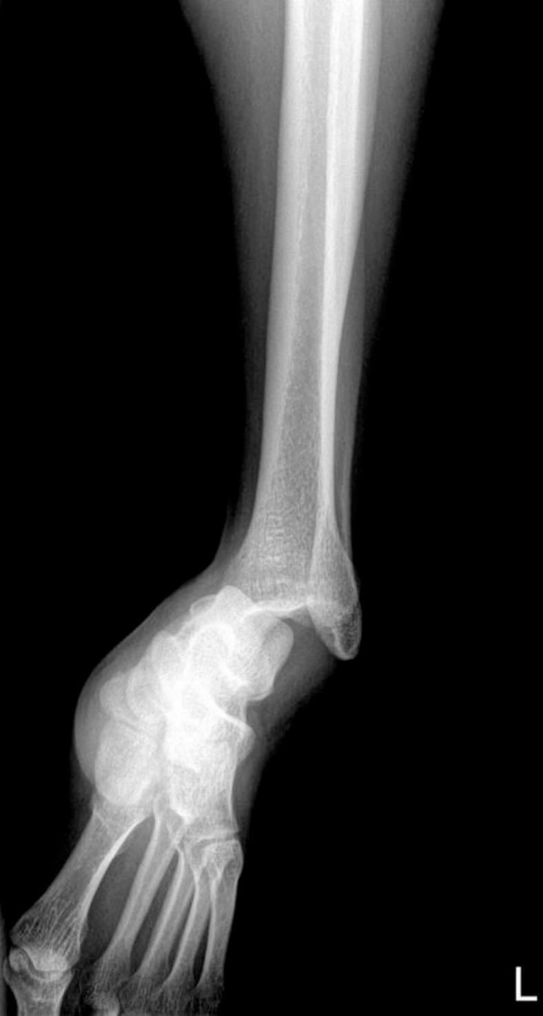 Preoperative AP and lateral radiographs of pure tibiotalar ankle dislocation