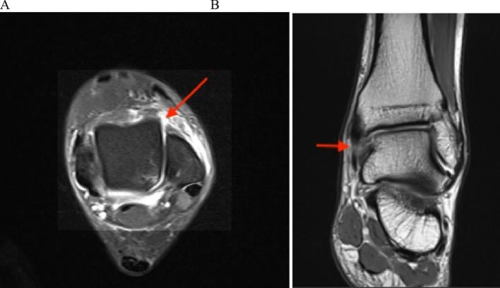 Coronal PD FS MRI demonstrating complete capsuloligamentous disruption in pure ankle dislocation