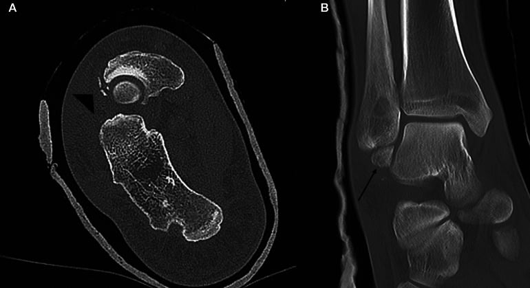Postreduction axial and coronal CT slices following total talar dislocation