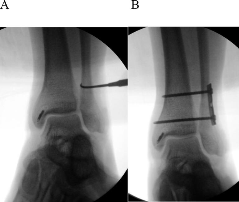 Intraoperative fluoroscopy demonstrating syndesmotic stress testing and suture button stabilization