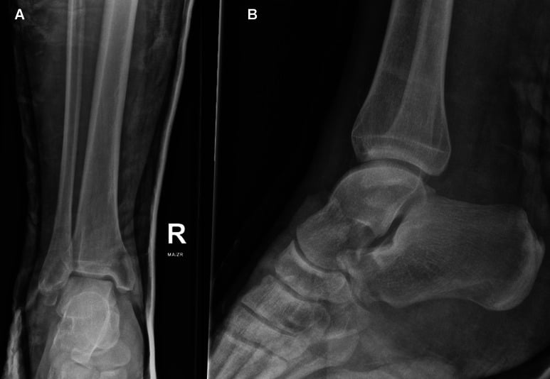 Postreduction AP and lateral radiographs showing complete closed reduction of total talar dislocation