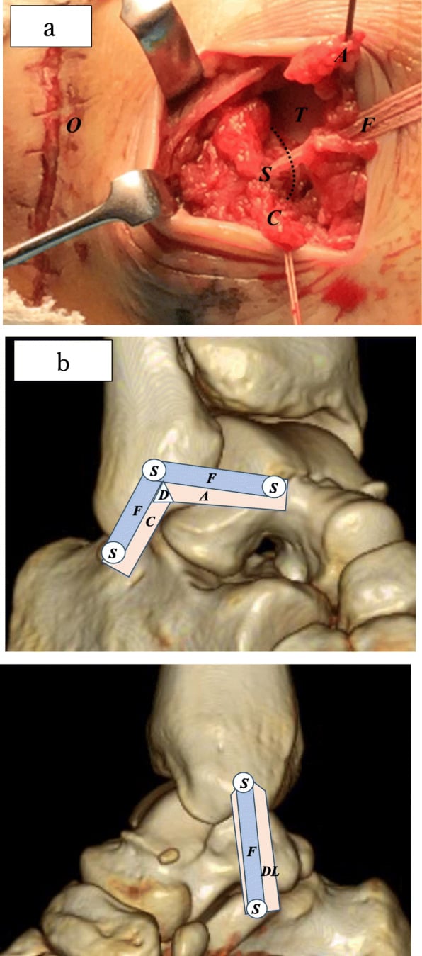 Operative view and schematic of anterior talofibular, calcaneofibular and deltoid ligament repair