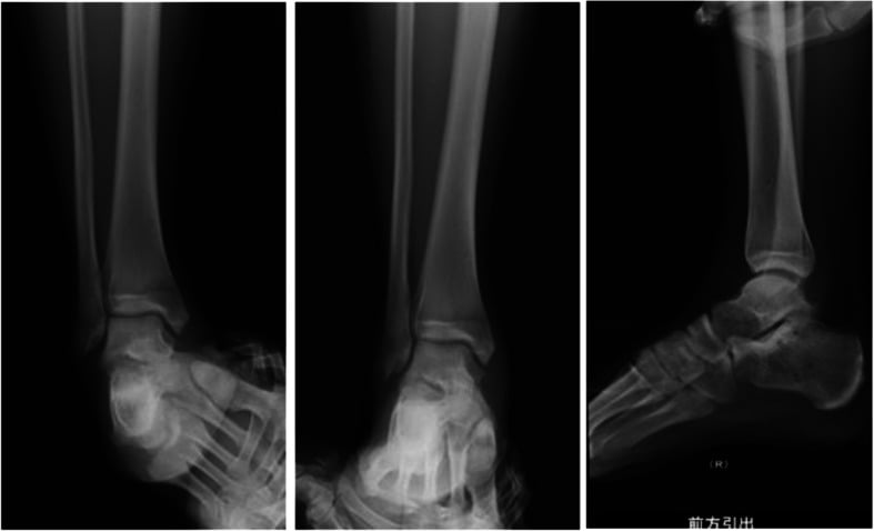 Varus, valgus and anterior-drawer stress radiographs after pure ankle dislocation treatment