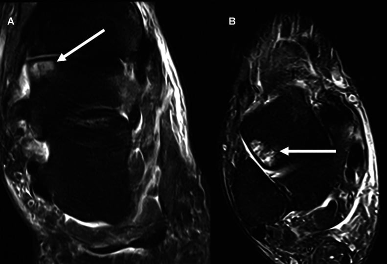 Coronal and axial fat-suppressed MRI showing talar head impaction and marrow oedema
