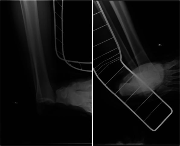 Anteroposterior and lateral radiographs, taken through a splint, showing medial pure tibiotalar dislocation