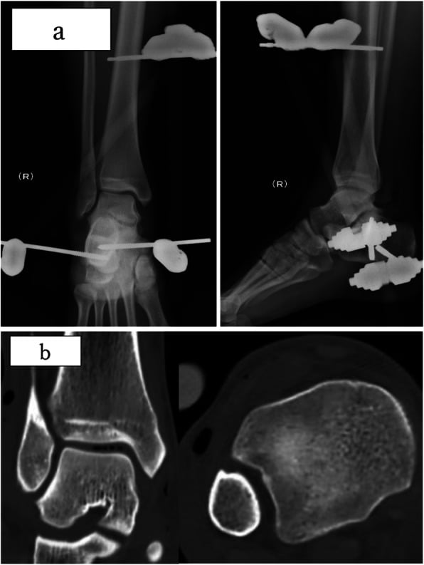 Radiographs and CT after reduction of an open pure ankle dislocation with external fixation