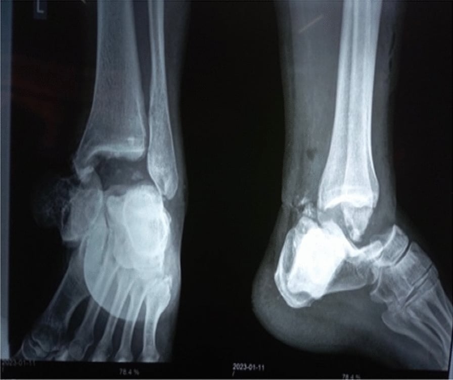 Anteroposterior and lateral radiographs showing open total talar dislocation
