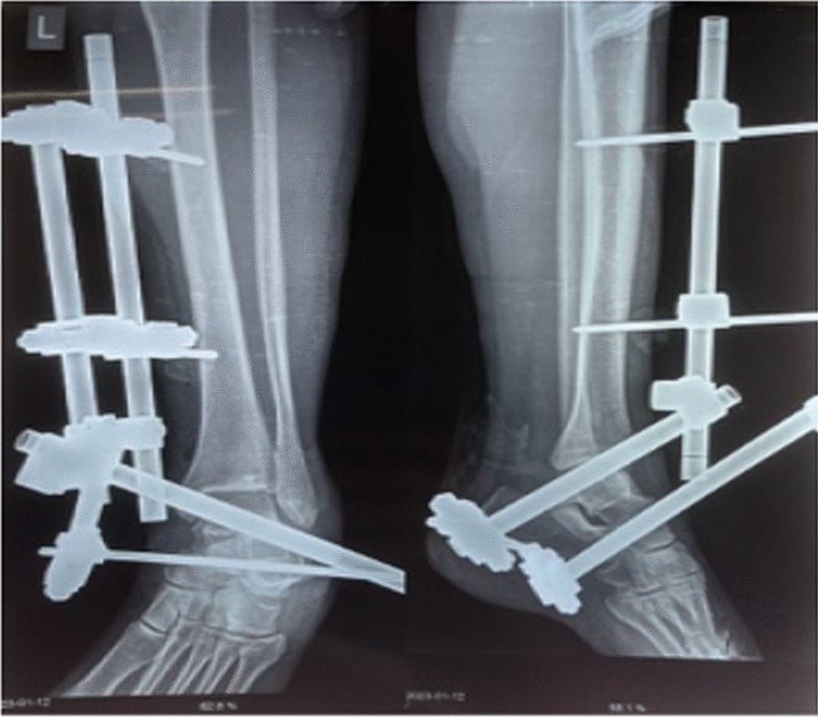 Anteroposterior and lateral radiographs showing reduced total talar dislocation stabilised by external fixation