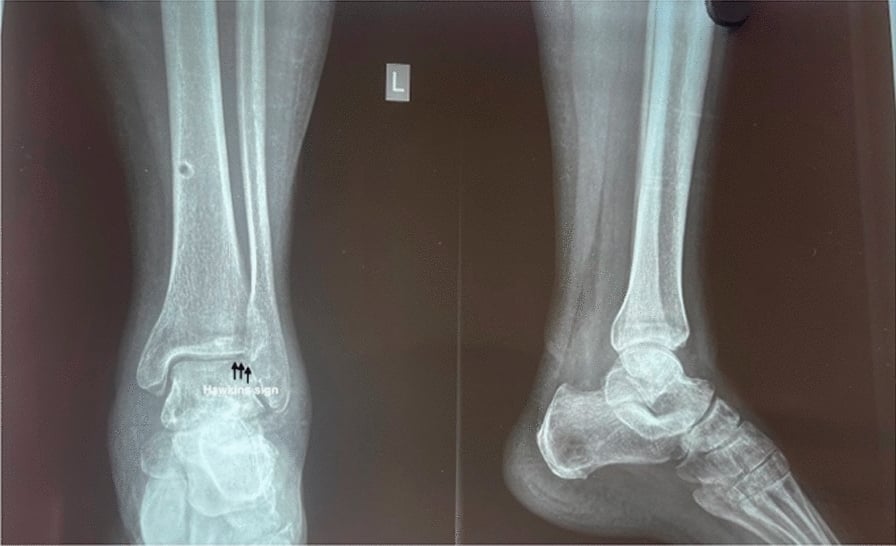Six-month ankle radiographs showing maintained talar alignment and a Hawkins sign