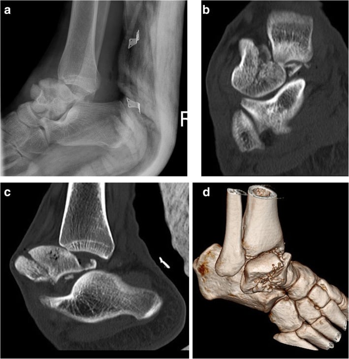 Radiograph, CT and 3D CT reconstruction showing pantalar fracture-dislocation with comminuted talar head and neck fracture