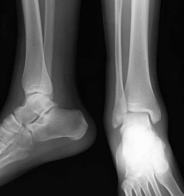 Anteroposterior and lateral radiographs showing restored tibiotalar congruity after reduction
