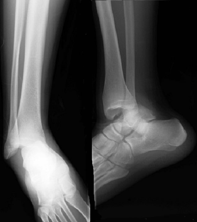 Anteroposterior and lateral radiographs showing pure posteromedial tibiotalar dislocation