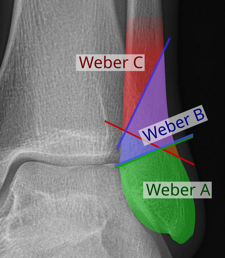 Danis-Weber classification diagram showing fibula fracture levels relative to the syndesmosis