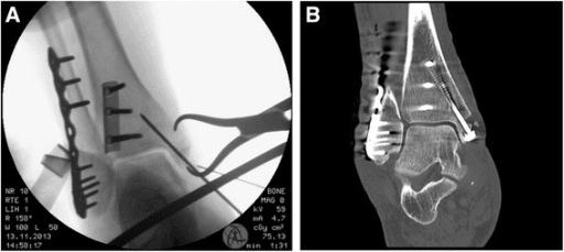 Ankle ORIF with intraoperative fluoroscopy and CT confirmation