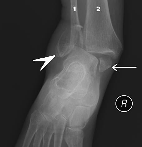Anteroposterior X-ray of the right ankle showing bimalleolar fracture with ankle dislocation
