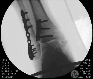 Intraoperative fluoroscopy showing lateral malleolus ORIF