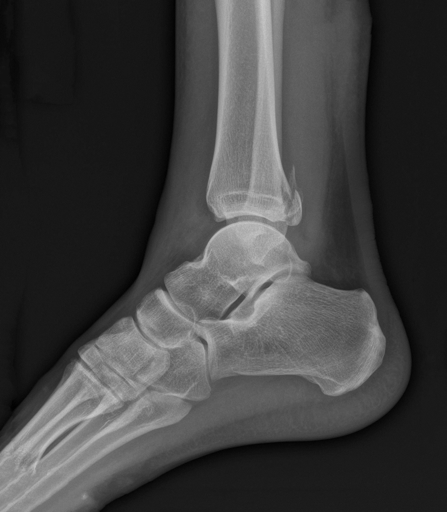 X-ray showing Maisonneuve fracture at the ankle level with syndesmotic widening