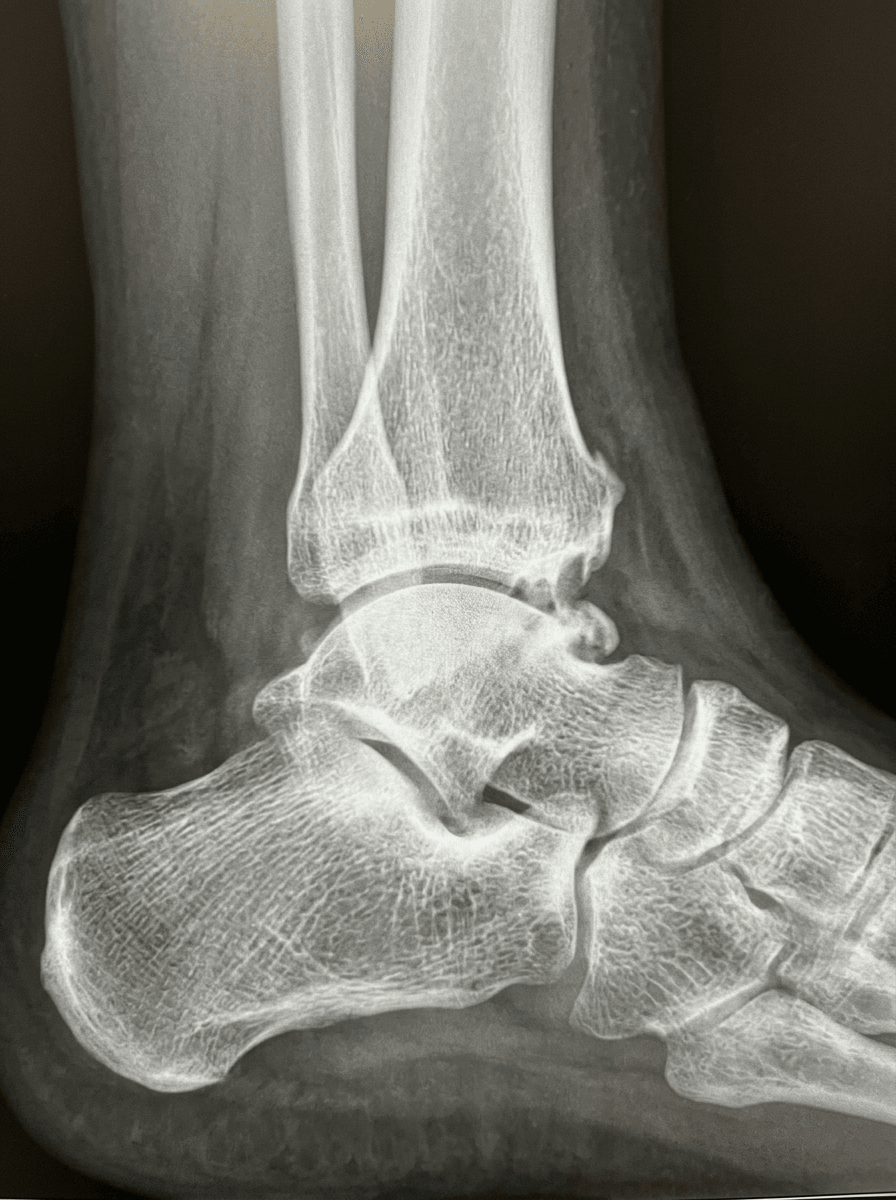Weight-bearing lateral radiograph of the ankle, the first-line view for assessing anterior ankle impingement.