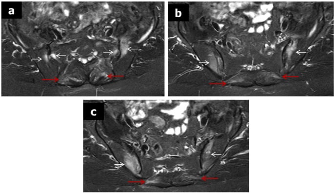Axial fat-suppressed T2 MRI showing bilateral subchondral sacroiliac bone marrow oedema and enthesitis