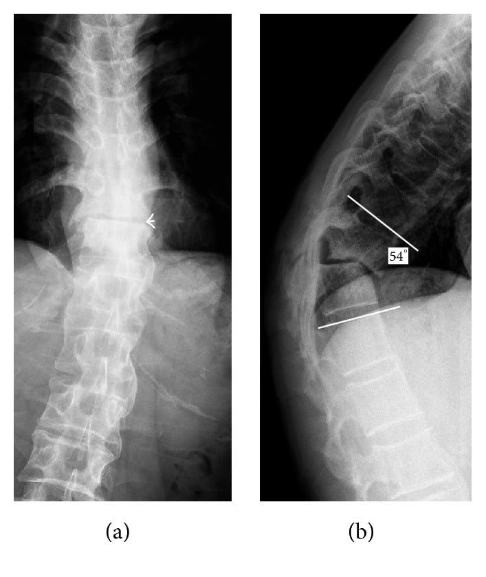 AP and lateral radiographs showing thoracolumbar pseudarthrosis and focal kyphosis in ankylosing spondylitis