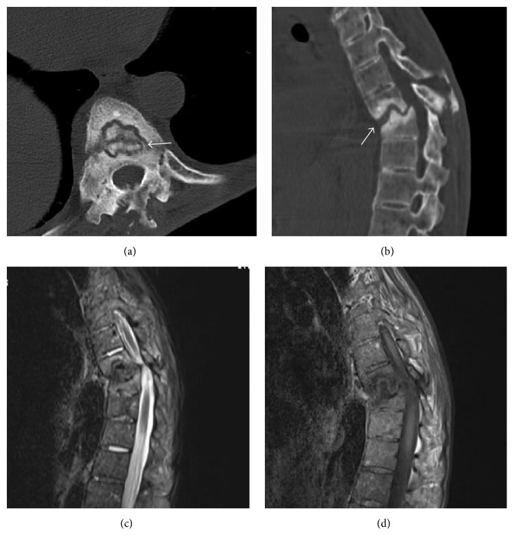 CT and MRI showing an Andersson lesion with vacuum phenomenon, three-column gap and adjacent sclerosis