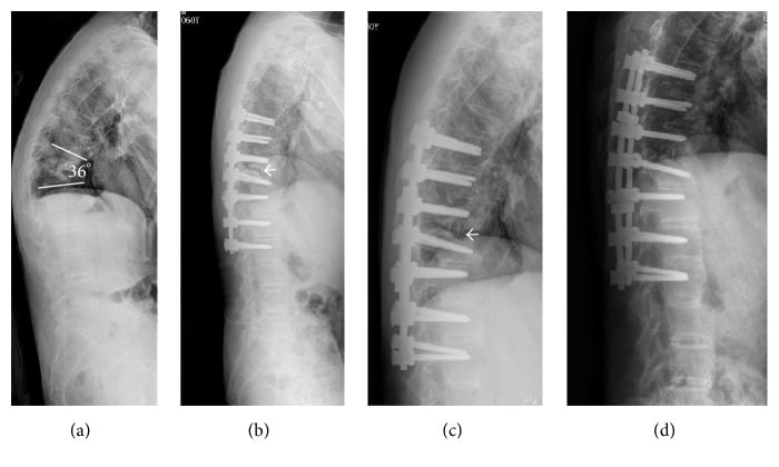 Serial lateral radiographs before and after transpseudarthrosis osteotomy, interbody fusion and long fixation