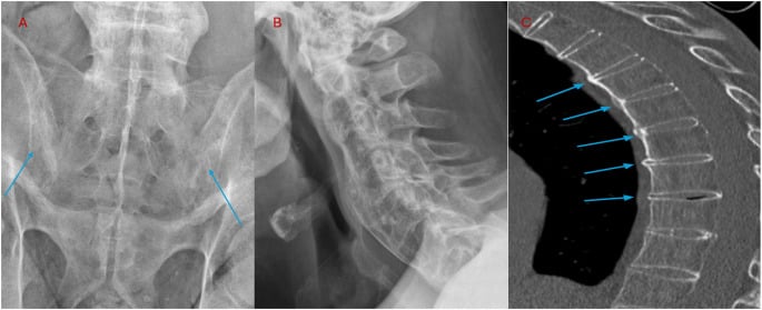 Pelvic and cervical radiographs with thoracic CT showing sacroiliitis, bamboo spine and thin marginal syndesmophytes