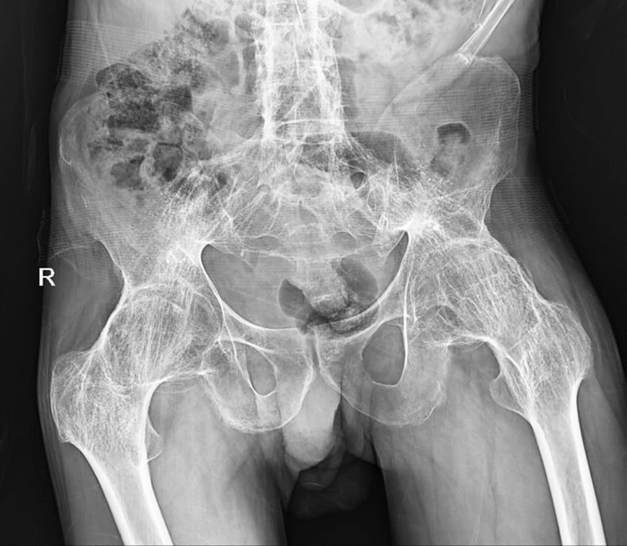 Pelvic radiograph showing bilateral bony hip ankylosis with a fused bamboo lumbar spine