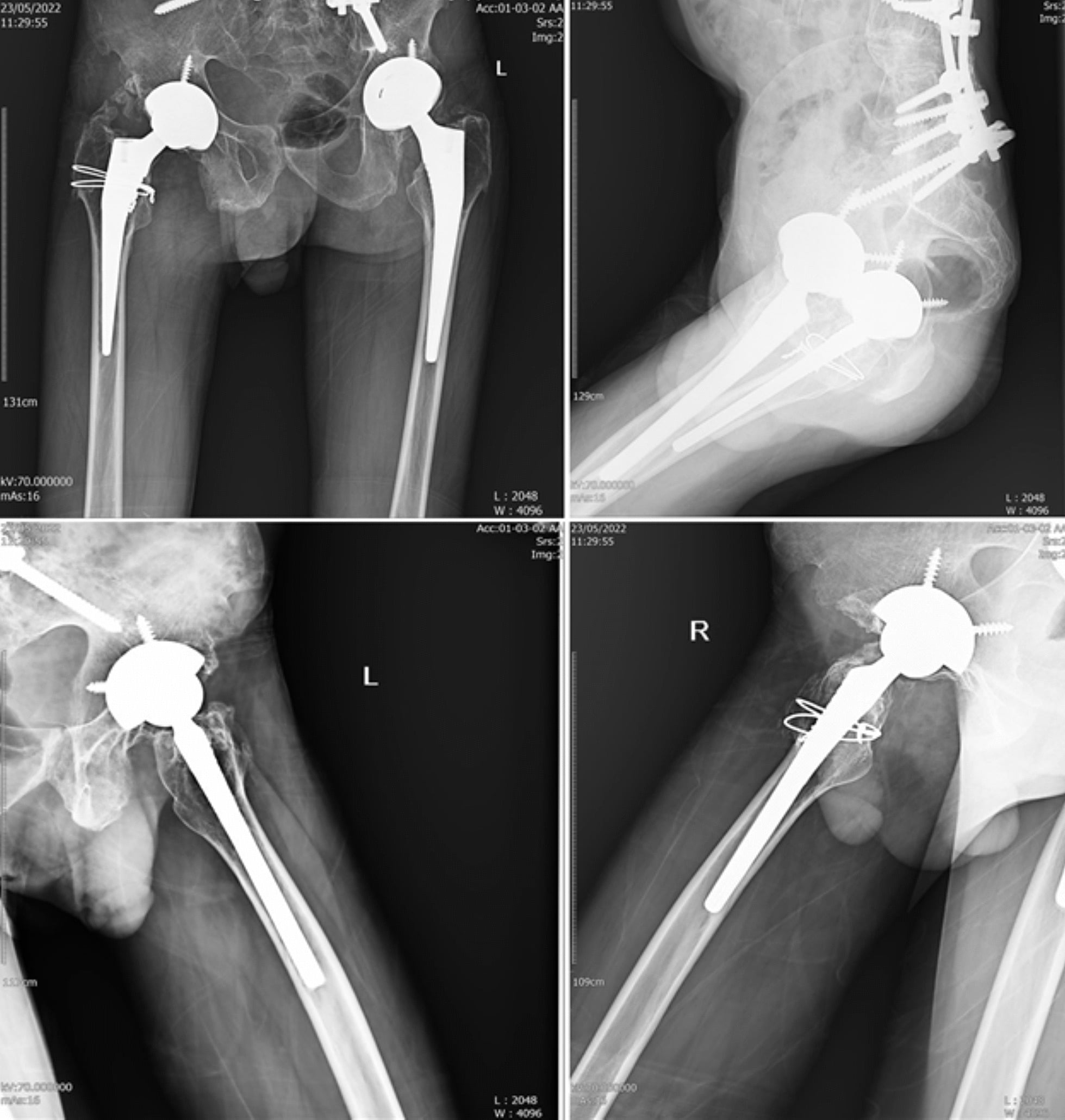 Postoperative pelvic and lateral hip radiographs after bilateral total hip arthroplasty for fused hips