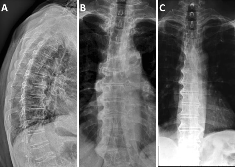 Thoracic and lumbar radiographs showing thick flowing anterior ossification across multiple levels in DISH