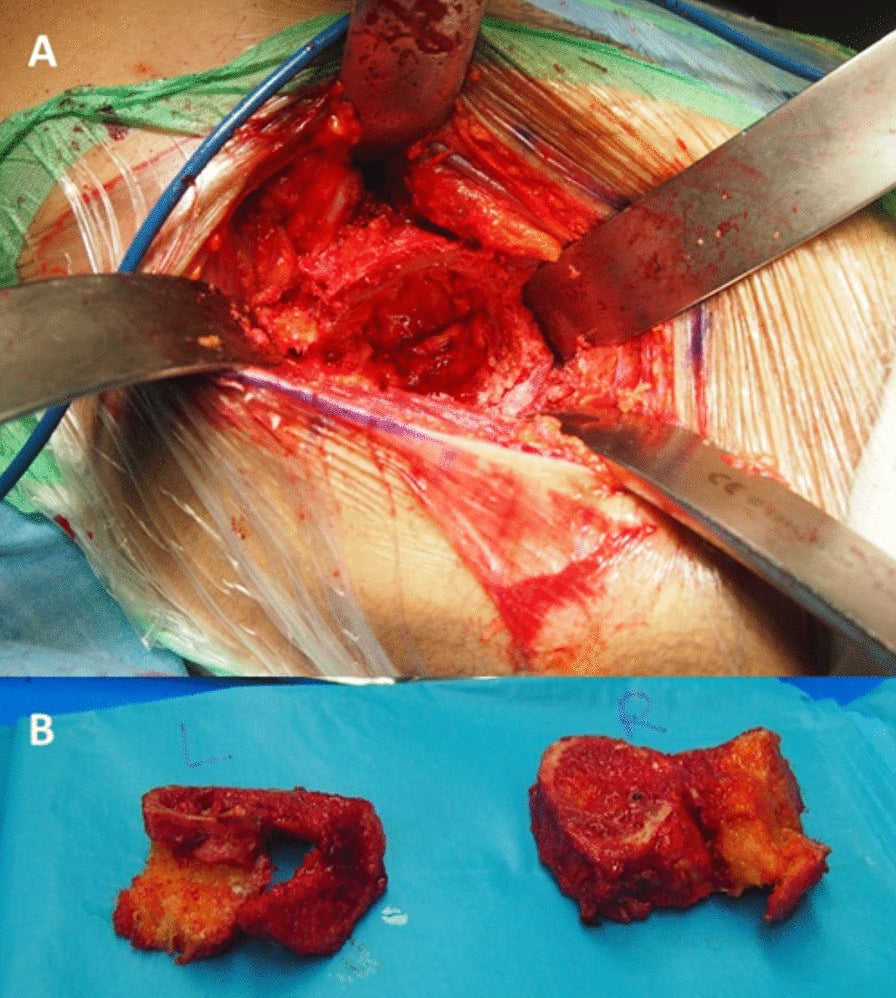 Intraoperative view and excised bone blocks during conversion of fused hips to total hip arthroplasty