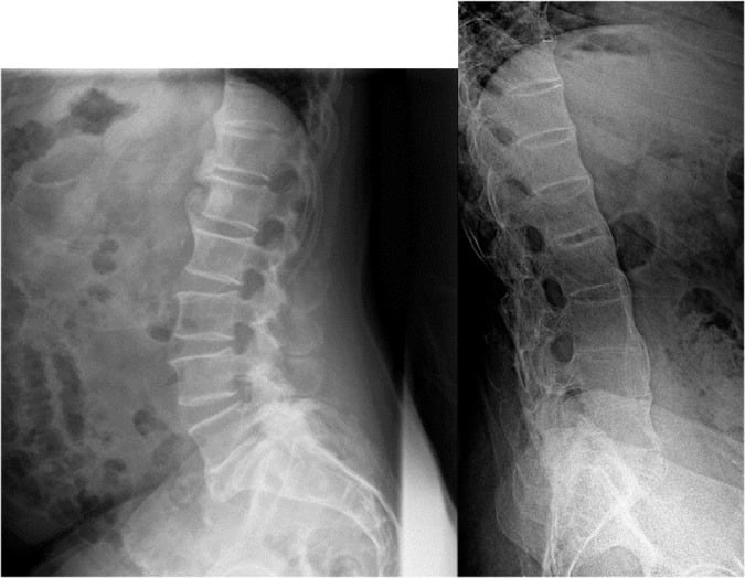 Spinal radiographs comparing coarse psoriatic syndesmophytes with thin marginal bamboo-spine change