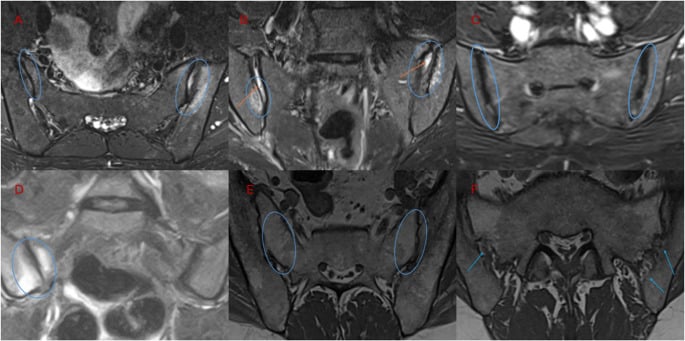MRI comparison of inflammatory sacroiliitis, postpartum change and osteitis condensans ilii